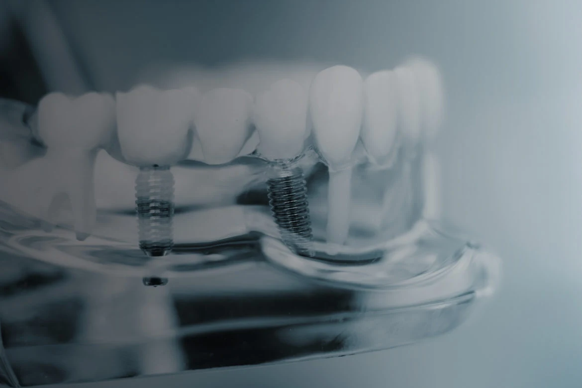 Impianti dentali: cosa sapere
